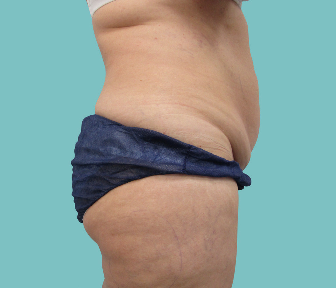 Abdomen antes de CoolTech