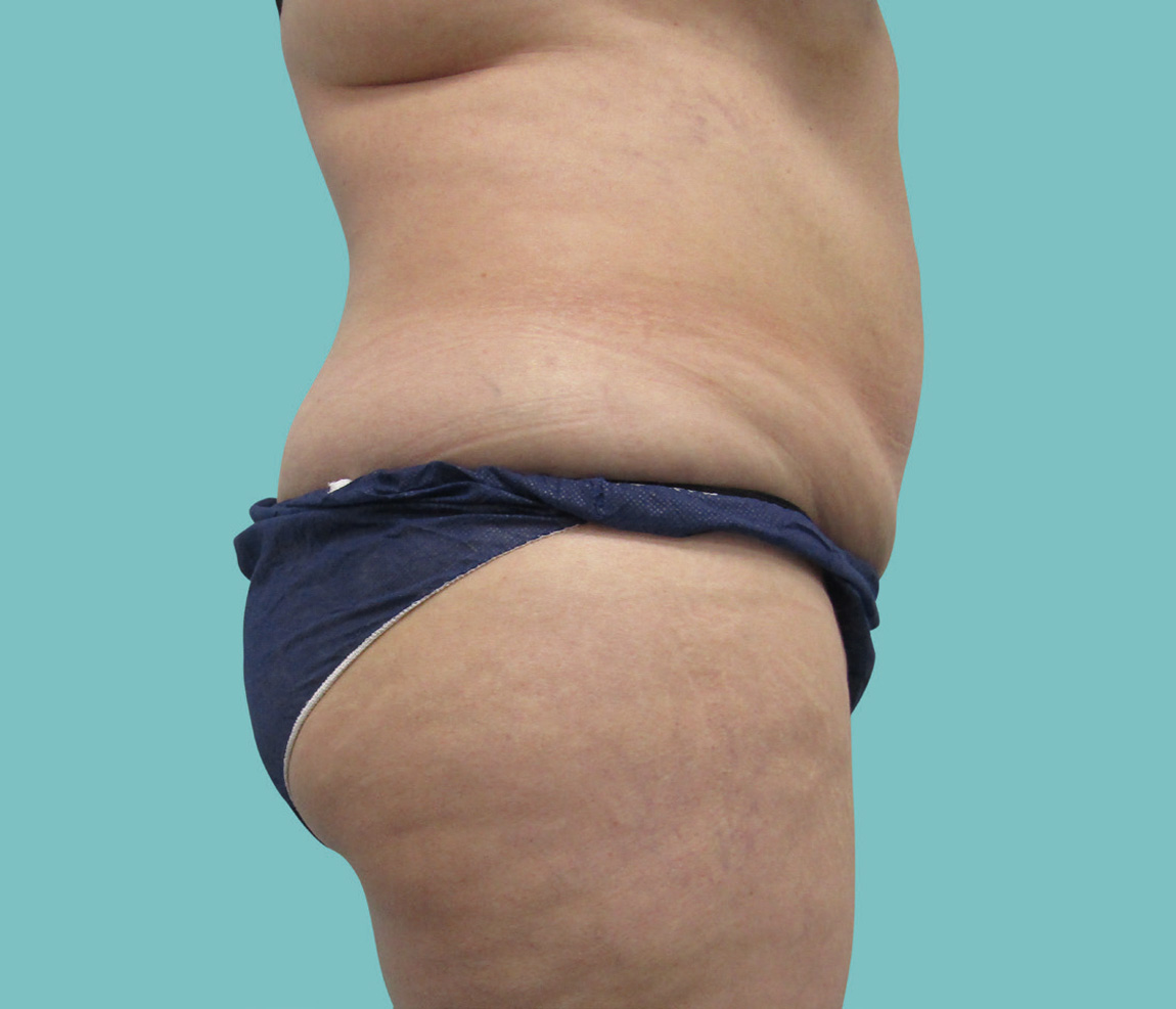 Abdomen después de CoolTech