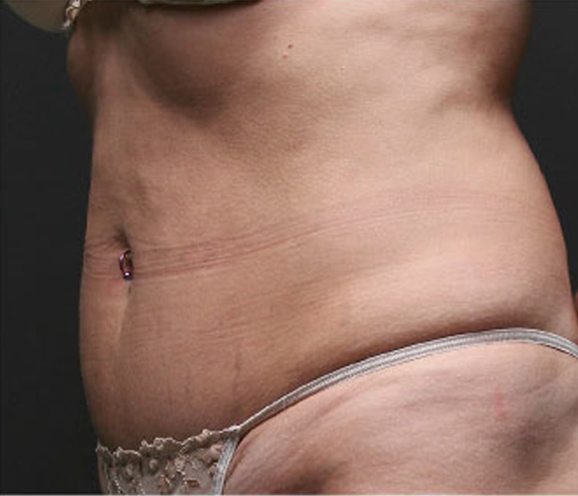 Cuerpo después del tratamiento Thermage