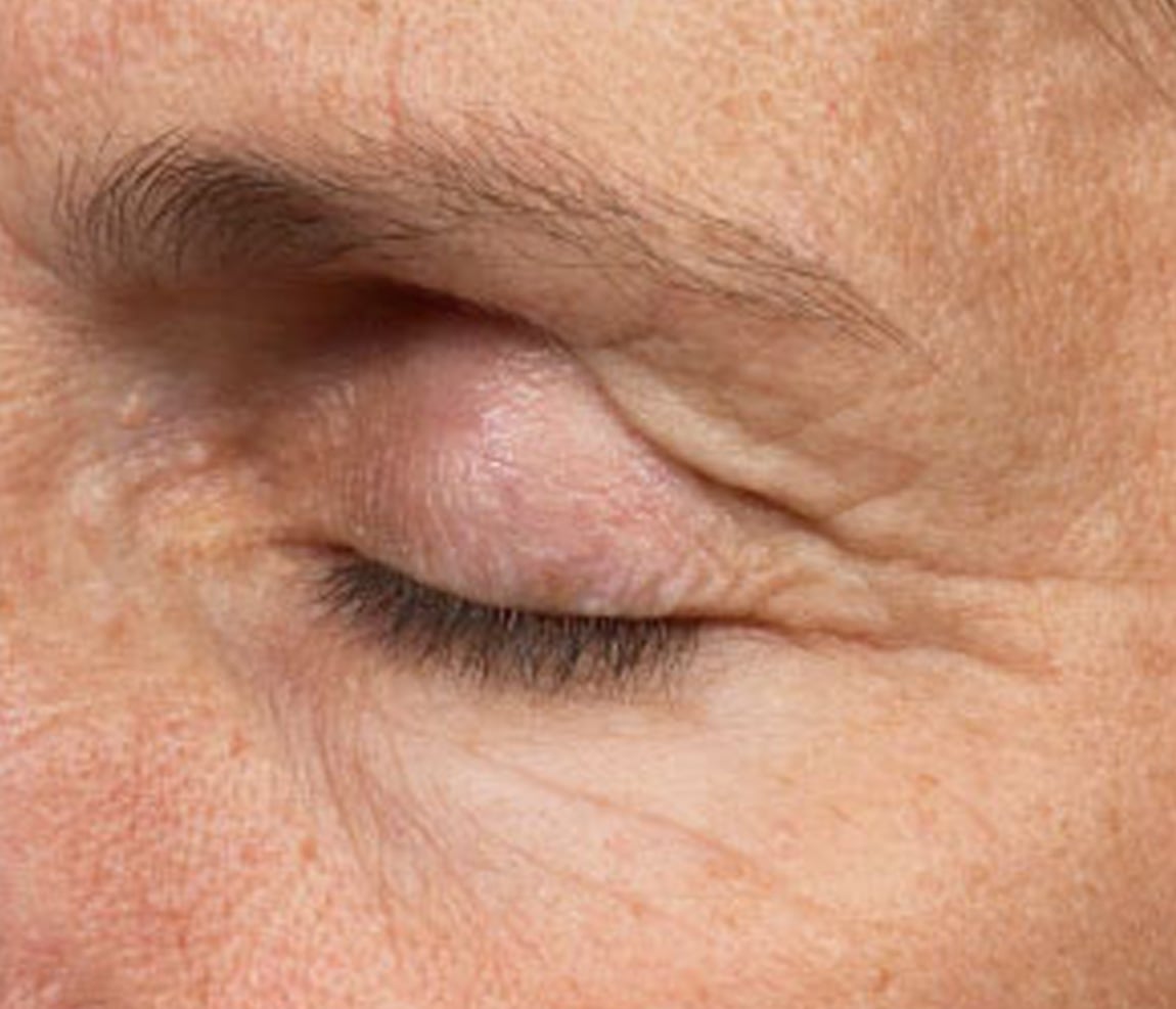Ojos antes del tratamiento Thermage