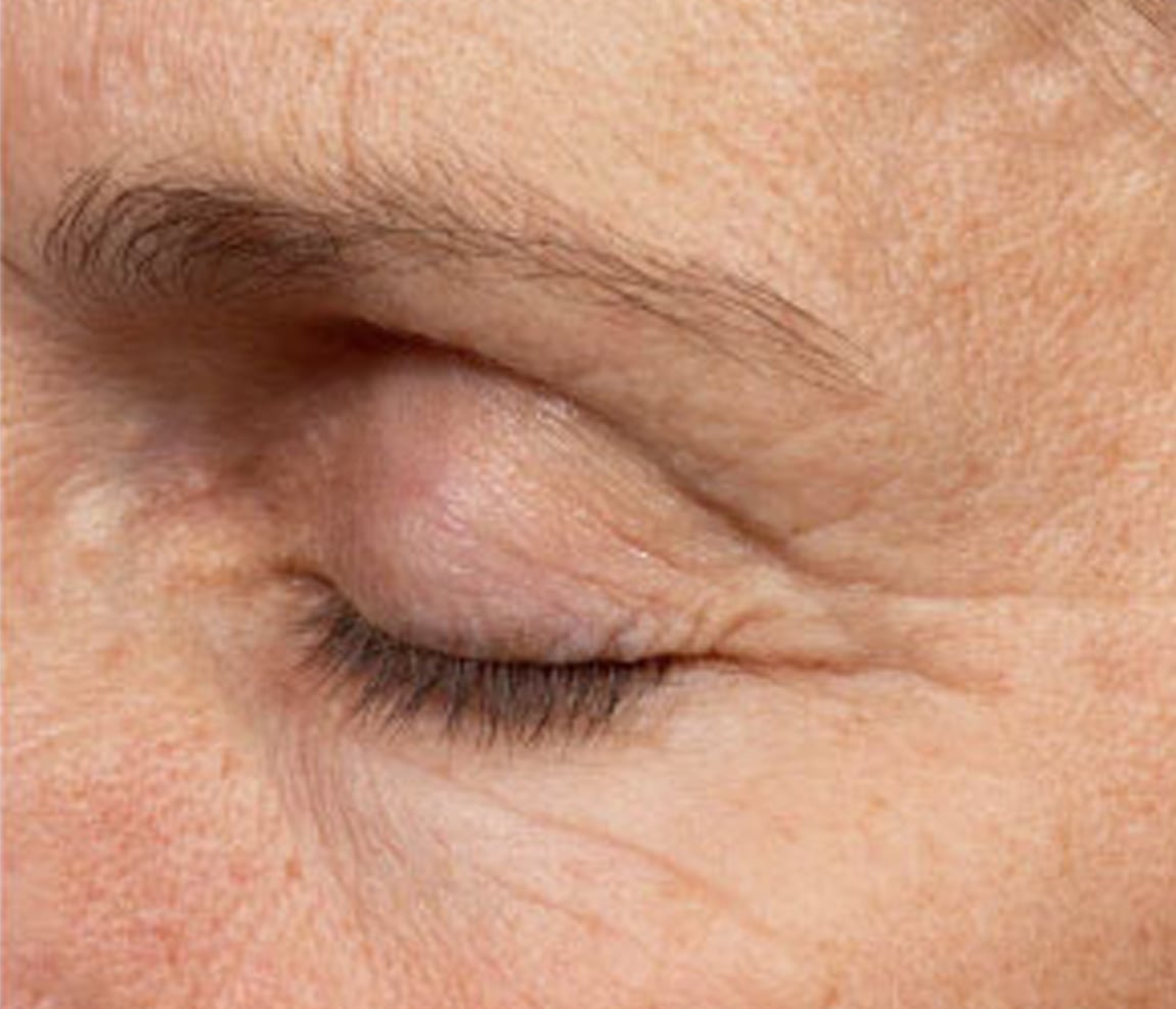 Ojos después del tratamiento Thermage