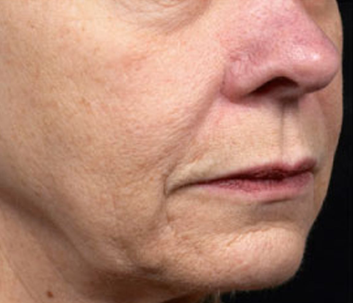 Rostro antes del tratamiento Thermage