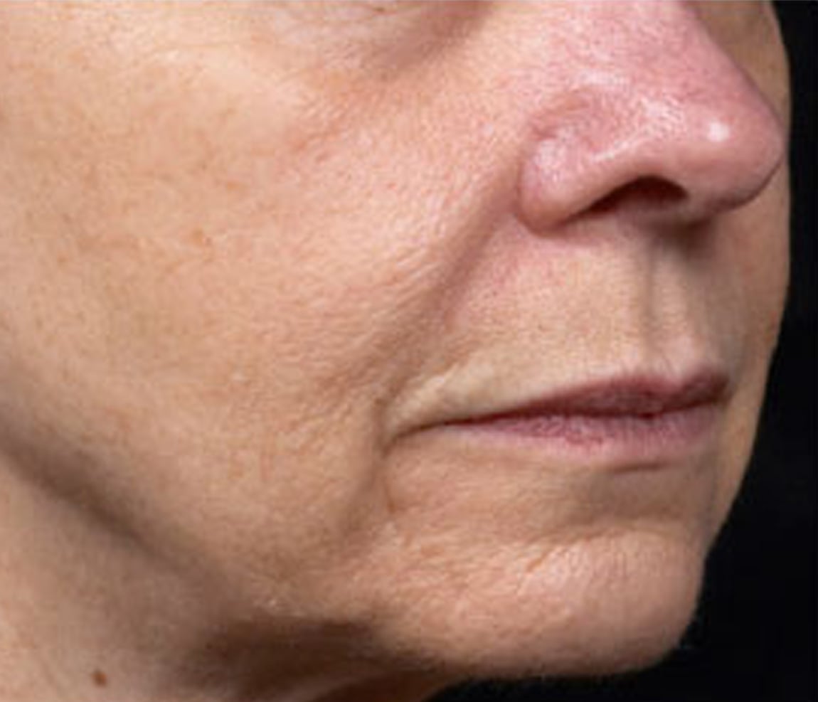 Rostro después del tratamiento Thermage