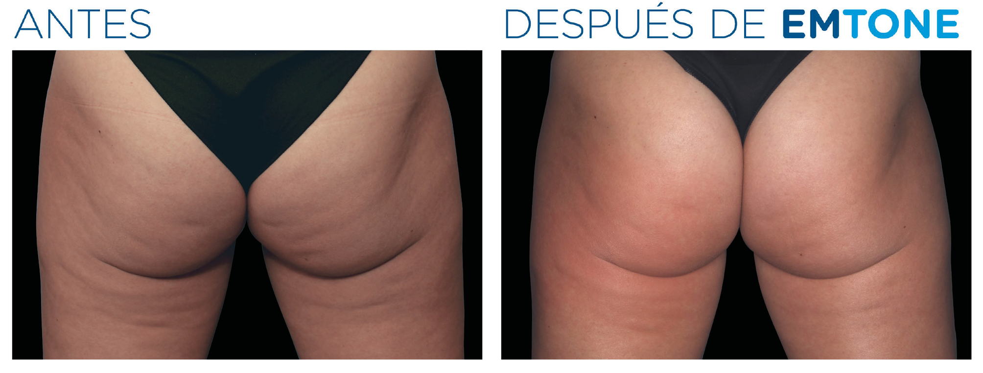 Antes y después de EMTONE — glúteos