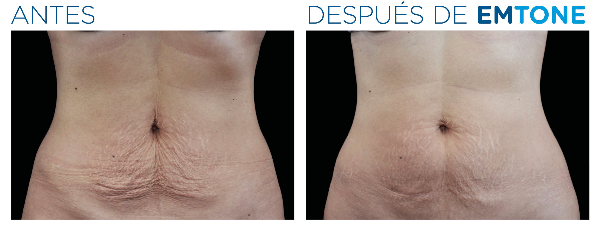Antes y después de EMTONE — abdomen
