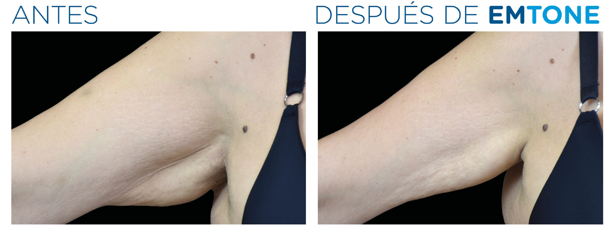 Antes y después de EMTONE — brazos