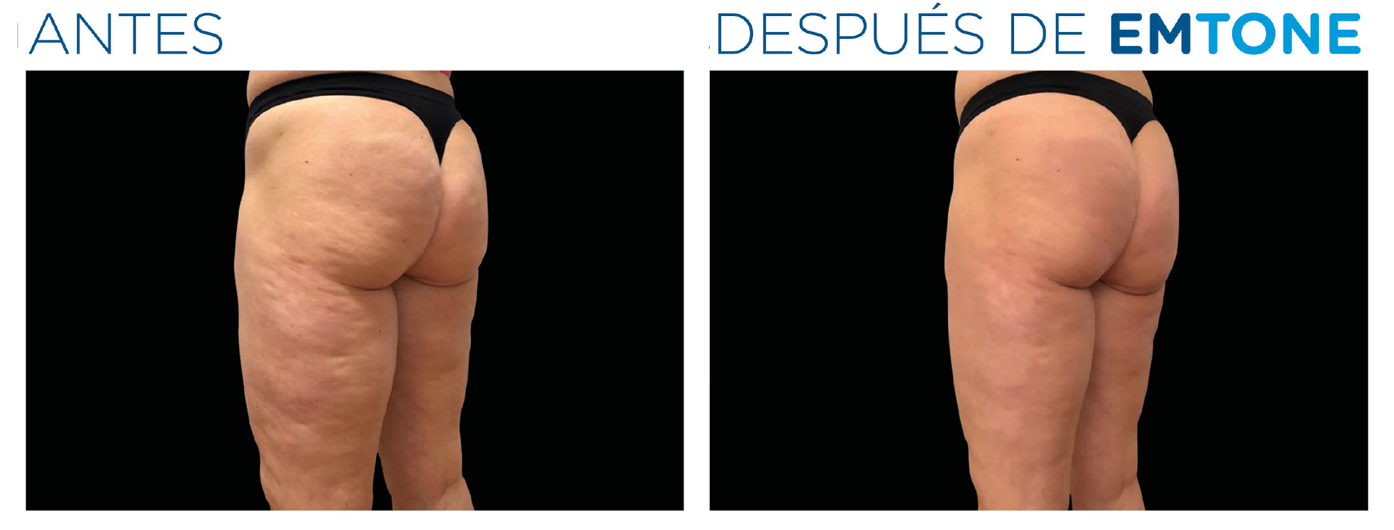 Antes y después de EMTONE — piernas