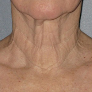 Cuello antes del tratamiento