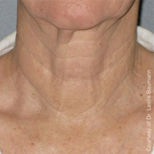 Cuello después del tratamiento