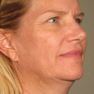 Rostro antes del tratamiento